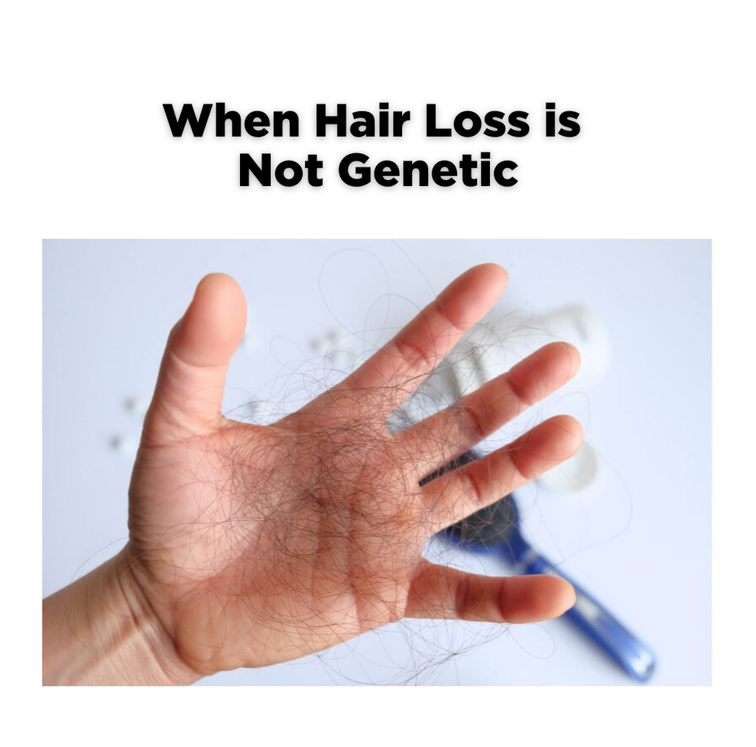 When Hair Loss Is Not Genetic